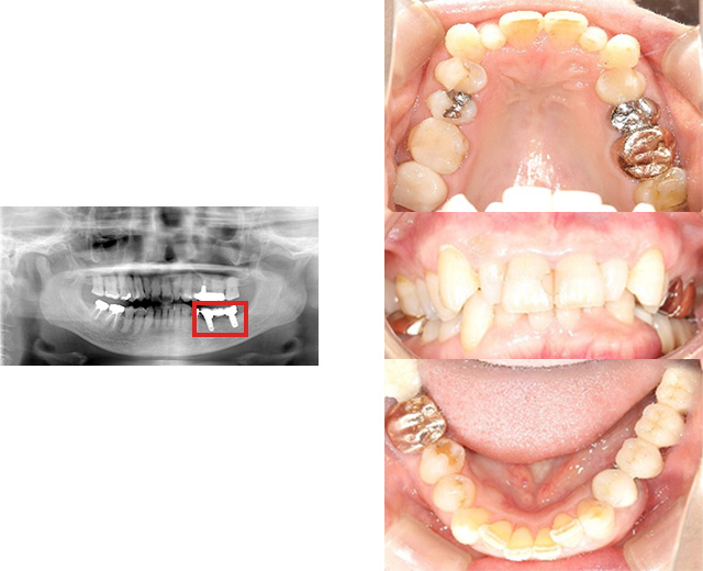 清誠歯科のインプラント治療症例⑥ 60代女性【ブリッジが取れてしまい、インプラント治療をされた症例】AFTER