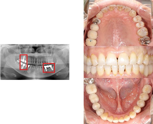 清誠歯科のインプラント治療症例⑦ 60代女性【入れ歯やブリッジの部位をインプラントにされた症例】AFTER